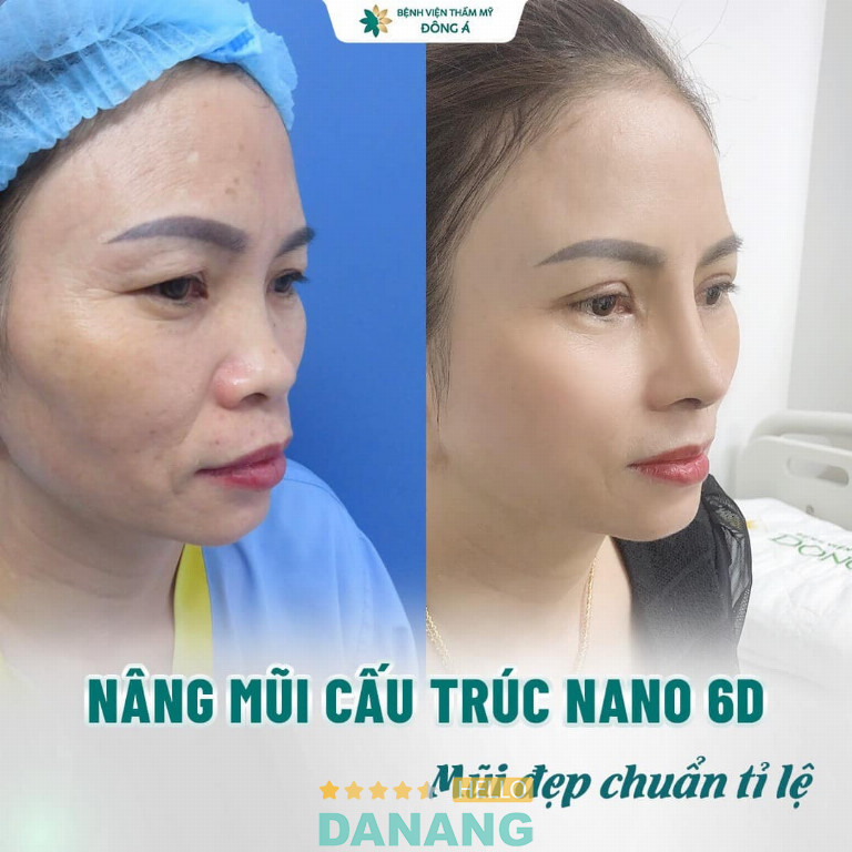 Địa chỉ nâng mũi tại Đà Nẵng an toàn