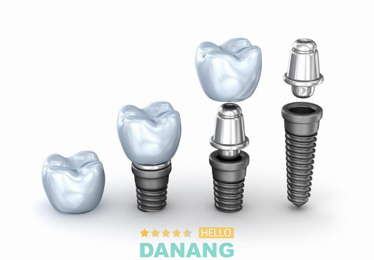 trụ implant