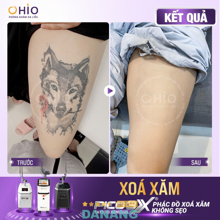 Phòng khám Chuyên khoa da liễu OHIO