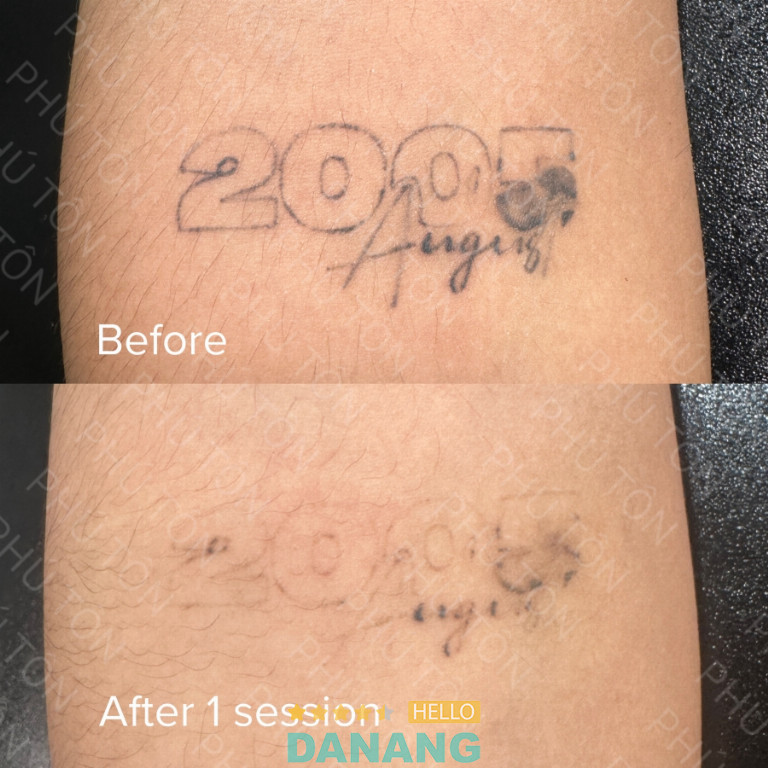 Xóa xăm Đà Nẵng Phú Tôn