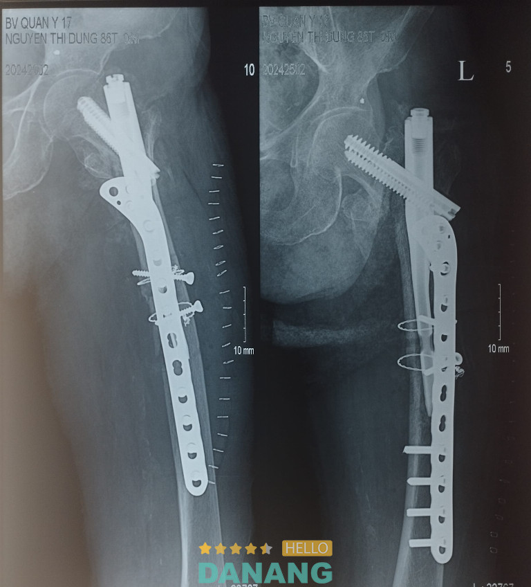 Bệnh viện Quân y 17 – P. Hòa Cường