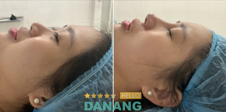 Nâng mũi thẩm mỹ bảo ân bs truyễn đà nẵng