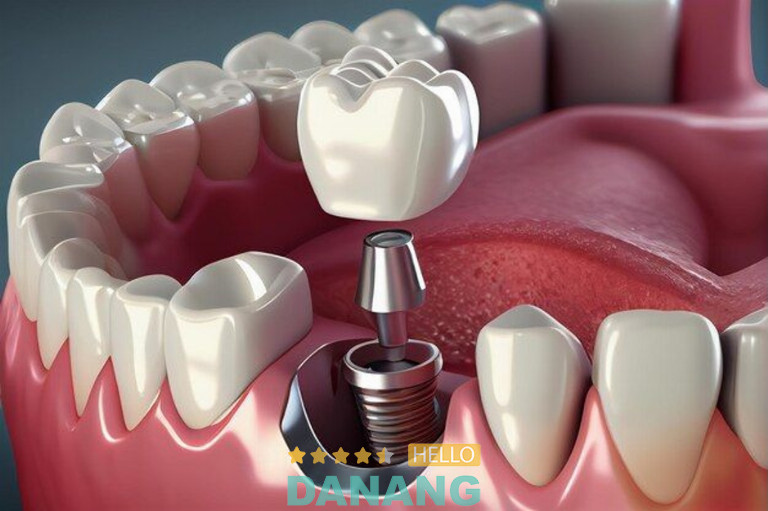 Trồng răng Implant là giải pháp phục hồi răng mất được đánh giá cao về độ bền và tính thẩm mỹ
