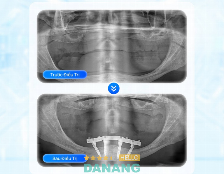 Thời gian tích hợp xương dao động 3-6 tháng tùy vị trí răng mất và tình trạng xương hàm của từng khách hàng