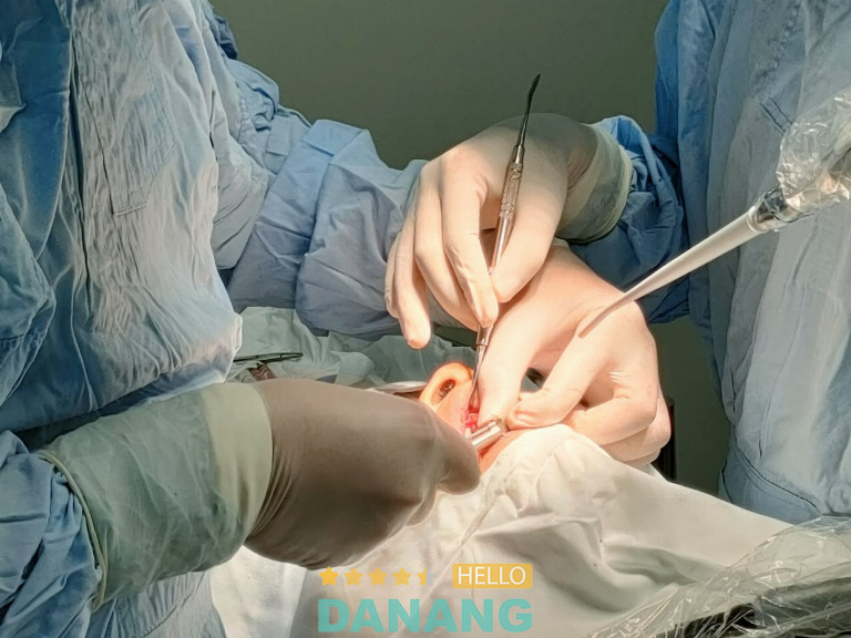 Trồng răng Implant mất bao lâu
