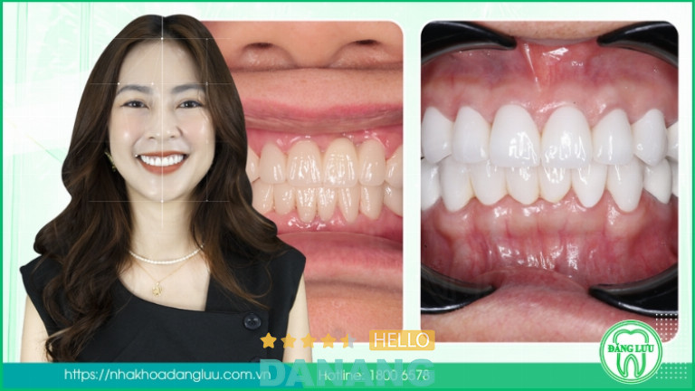 Bọc răng sứ tại Nha Khoa Đăng Lưu mang lại hiệu quả cao về thẩm mỹ