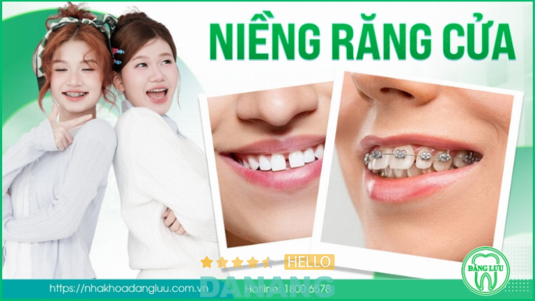 Niềng răng cửa