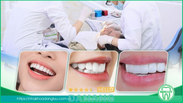 Bọc răng sứ tại Nha Khoa Đăng Lưu